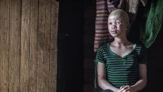 La poursuite et le meurtre rituel des albinos augmentent au Malawi