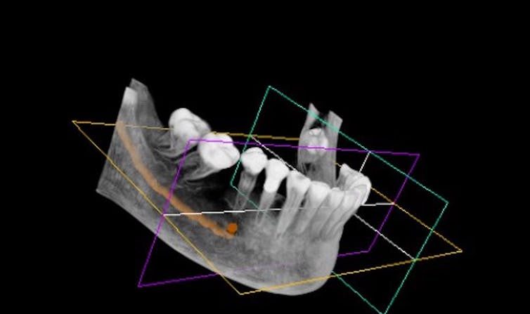 Mâchoire numérisée. (Dent3D/Wikimedia, CC BY)