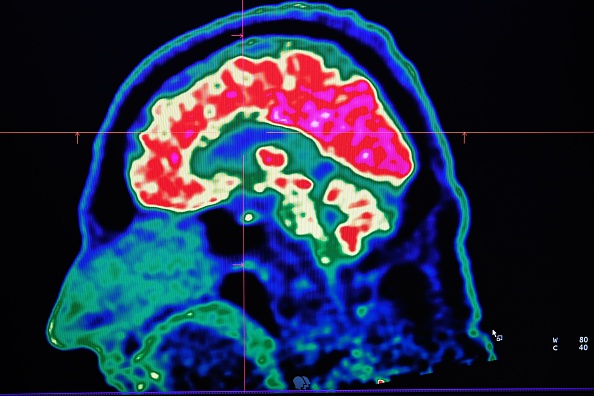 -Le CHRU de Brest vient d'acquérir un nouvel appareil d'imagerie moléculaire, le plus avancé de France aujourd'hui selon le centre hospitalier, capable de mieux détecter les lésions profondes et en particulier les pathologies cancéreuses, a annoncé l'hôpital le 9 janvier 2019. Photo by Fred TANNEAU / AFP / Getty Images.