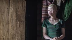 Trois condamnations à la peine capitale pour le meurtre d’un albinos au Malawi