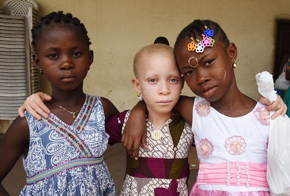 -Illustration- Un enfant albinos pose pour une photo avec d'autres enfants le 31 août 2016 à Abidjan, lors d'une distribution de lunettes de soleil et de protections solaires. Photo SIA KAMBOU / AFP / Getty Images.