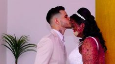 Une femme atteinte d’une rare maladie de la peau trouve l’âme sœur : « L’amour existe, croyez-moi ! »