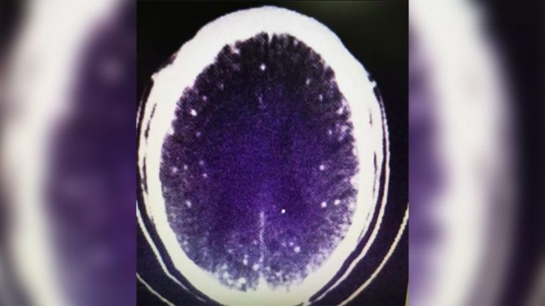 Des ténias ont envahi le cerveau de cet homme parce qu'il avait consommé de la viande trop peu cuite. (First Affiliated Hospital de l'université de Zhejiang, Via CNN)