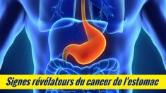 8 signes d’avertissement du cancer de l’estomac que vous ne devriez pas ignorer