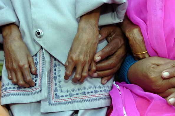 Image d'illustration : les mains d'un enfant atteint de progéria, une maladie génétique rare. (DESHAKALYAN CHOWDHURY/AFP via Getty Images)