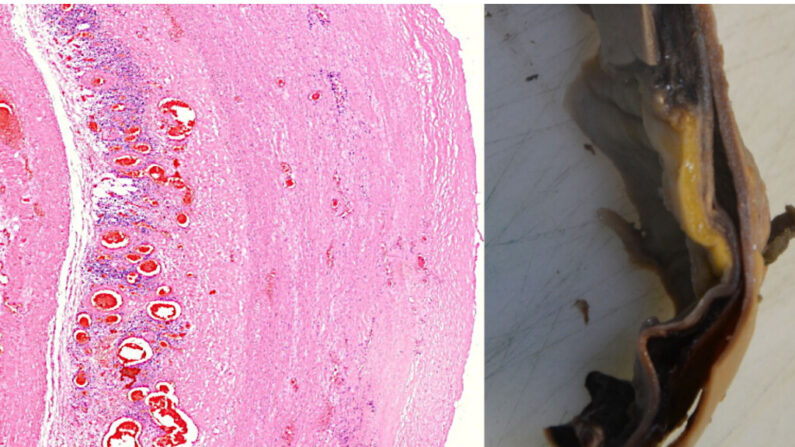 Une fissure dans la paroi de l'aorte, tapissée par des amas de lymphocytes, entraînant une rupture aortique. (Michael Palmer, MD, Sucharit Bhakdi, MD)