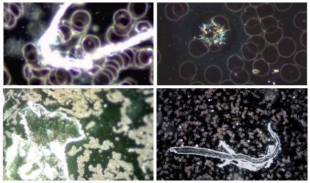 Figure 4 : Ces 4 images illustrent la variété de phénomènes et d'objets inhabituels trouvés dans le sang de sujets vaccinés avec Comirnaty (BioNTech/Pfizer). (German Working Group for COVID Vaccine Analysis, GWG)