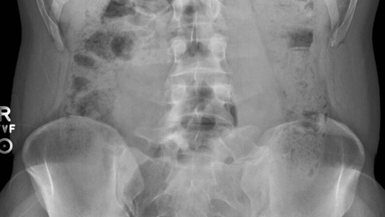 Radiographie non datée d’un adénocarcinome sur le sigmoïde, un type de cancer colorectal (US National Library of Medicine)