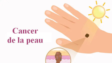 Le guide essentiel du cancer de la peau : symptômes, causes, traitements et approches naturelles