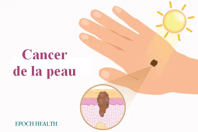 Le cancer de la peau est peut-être le cancer le plus répandu, mais heureusement, il est facilement traitable lorsqu'il est détecté tôt. (Illustrations de Shutterstock/Conçu par Epoch Times)