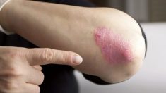 Une mauvaise adaptation au stress serait liée à un risque accru de psoriasis