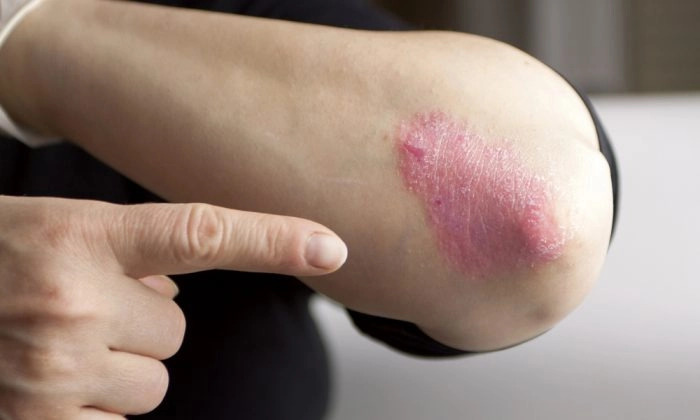 Psoriasis (Hriana/Shutterstock)