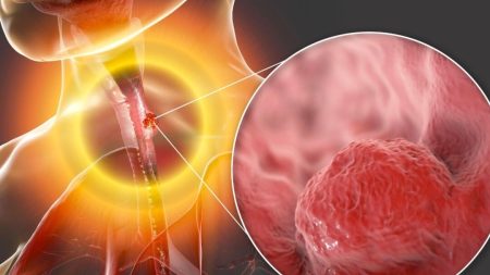 Surveiller les signes précurseurs du cancer de l’œsophage