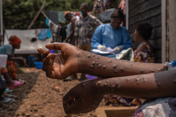 Un patient souffrant de la variole du singe est assis sur un banc à l'hôpital de Kavumu, à 30 km au nord de Bukavu au Congo. (GLODY MURHABAZI/AFP via Getty Images)