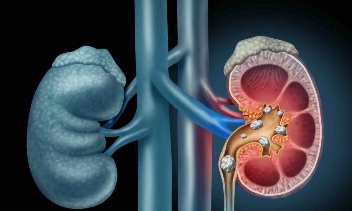 Une bactérie particulière présente dans l'urine peut contribuer à la protection contre les calculs rénaux