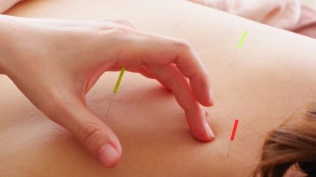 L’acupuncture s’avère efficace contre la sciatique