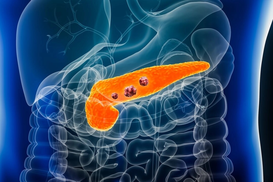 Le cancer du pancréas : les signes d'alerte négligés, les risques cachés et les stratégies de prévention