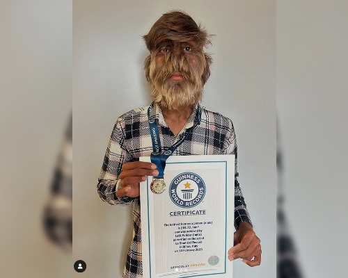 « Syndrome du loup-garou » : un jeune de 18 ans décroche le record du visage le plus poilu du monde