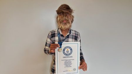 « Syndrome du loup-garou » : un jeune de 18 ans décroche le record du visage le plus poilu du monde